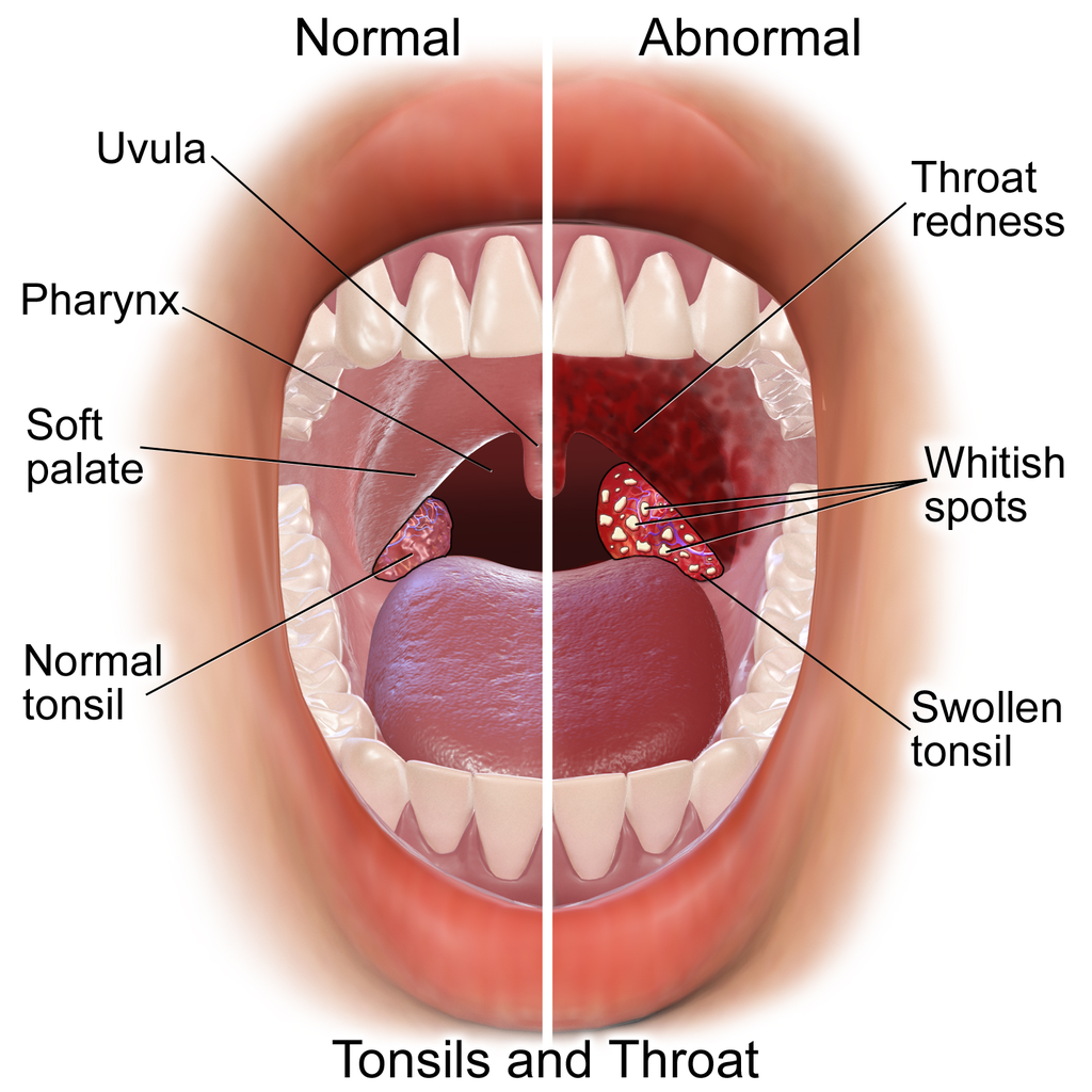 Image displaying sore throat vs normal throat